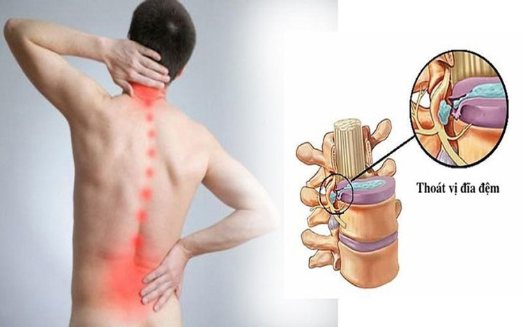 Thoát vị đĩa đệm là một trong những nguyên nhân chính dẫn đến đau lưng mạn tính